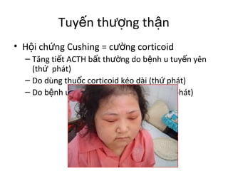 Tuyến thượng thận 
• Hội chứng Cushing = cường corticoid 
– Tăng tiết ACTH bất thường do bệnh u tuyến yên 
(thứ phát) 
– Do dùng thuốc corticoid kéo dài (thứ phát) 
– Do bệnh u tuyến thượng thận (nguyên phát) 
 
