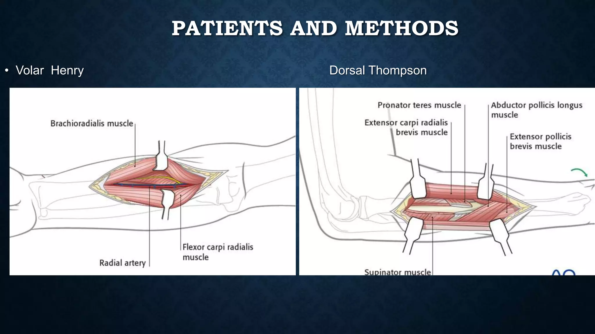Henry versus thompson approach for fixation of proximal third radial ...