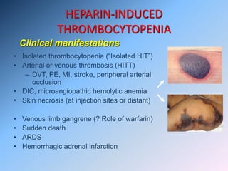 HEPARIN-INDUCED
THROMBOCYTOPENIA
• Isolated thrombocytopenia (“Isolated HIT”)
• Arterial or venous thrombosis (HITT)
– DVT, PE, MI, stroke, peripheral arterial
occlusion
• DIC, microangiopathic hemolytic anemia
• Skin necrosis (at injection sites or distant)
• Venous limb gangrene (? Role of warfarin)
• Sudden death
• ARDS
• Hemorrhagic adrenal infarction
Clinical manifestations
 