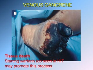 VENOUS GANGRENE
Tissue death
Starting warfarin too soon in HIT
may promote this process
 