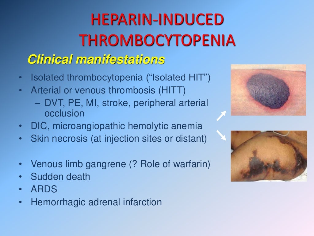 Heparine induced thrombocytopenia
