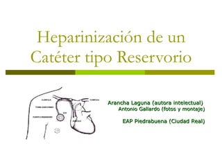Heparinización de un Catéter tipo Reservorio Arancha Laguna (autora intelectual)  Antonio Gallardo (fotos y montaje) EAP Piedrabuena (Ciudad Real) 