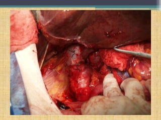 Hepatectomía derecha