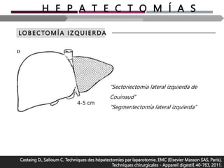 H E P A T E C T O M Í A S
LO BE CTOMÍA I Z Q UI ERDA
Castaing D., Salloum C. Techniques des hépatectomies par laparotomie. EMC (Elsevier Masson SAS, Paris),
Techniques chirurgicales - Appareil digestif, 40-763, 2011.
“Sectoriectomía lateral izquierda de
Couinaud”
“Segmentectomía lateral izquierda”
4-5 cm
 