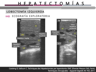 H E P A T E C T O M Í A S
LO B E CTOMÍA I Z Q U I ERDA
E C O G R A F Í A E X P LO R ATO R I A
Castaing D, Salloum C. Techniques des hépatectomies par laparotomie. EMC (Elsevier Masson SAS, Paris),
Techniques chirurgicales - Appareil digestif, 40-763, 2011.
 