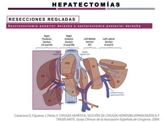 R E S E C C I O N E S R E G L AD A S
Casanova D, Figueras J, Pardo F. CIRUGÍA HEPÁTICA. SECCIÓN DE CIRUGÍA HEPATOBILIOPANCREÁTICA Y
TRASPLANTE. Guías Clínicas de la Asociación Española de Cirujanos. 2004.
H E P A T E C T O M Í A S
S e c c i o n e c t o m i a p o s e r i o r d e r e c h a o s e c t o r e c t o m í a p o s t e r i o r d e r e c h a
 