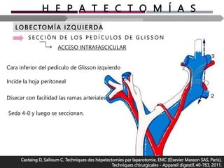 H E P A T E C T O M Í A S
LO B E CTOMÍA I Z Q U I ERDA
S E CC I Ó N D E LO S P E D Í C U LO S D E G L I S S O N
Castaing D, Salloum C. Techniques des hépatectomies par laparotomie. EMC (Elsevier Masson SAS, Paris),
Techniques chirurgicales - Appareil digestif, 40-763, 2011.
ACCESO INTRAFASCICULAR
Cara inferior del pedículo de Glisson izquierdo
Incide la hoja peritoneal
Disecar con facilidad las ramas arteriales
Seda 4-0 y luego se seccionan.
 