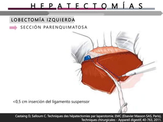 H E P A T E C T O M Í A S
LO B E CTOMÍA I Z Q U I ERDA
S E CC I Ó N PA R E N Q U I M ATO S A
Castaing D, Salloum C. Techniques des hépatectomies par laparotomie. EMC (Elsevier Masson SAS, Paris),
Techniques chirurgicales - Appareil digestif, 40-763, 2011.
<0,5 cm inserción del ligamento suspensor
 