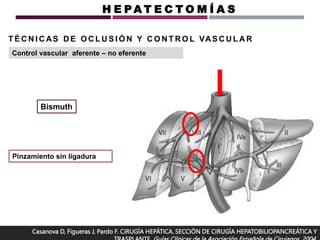 Casanova D, Figueras J, Pardo F. CIRUGÍA HEPÁTICA. SECCIÓN DE CIRUGÍA HEPATOBILIOPANCREÁTICA Y
Bismuth
Pinzamiento sin ligadura
T É C N I C AS D E O C L U S I Ó N Y C O N T R O L VAS C U L A R
Control vascular aferente – no eferente
H E P A T E C T O M Í A S
 