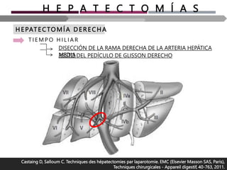 H E P A T E C T O M Í A S
H E PAT ECTOMÍA D E R E CH A
T I E M P O H I L I A R
RESTO DEL PEDÍCULO DE GLISSON DERECHO
Castaing D, Salloum C. Techniques des hépatectomies par laparotomie. EMC (Elsevier Masson SAS, Paris),
Techniques chirurgicales - Appareil digestif, 40-763, 2011.
DISECCIÓN DE LA RAMA DERECHA DE LA ARTERIA HEPÁTICA
MEDIA
 