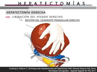 H E P A T E C T O M Í A S
H E PAT ECTOMÍA D E R E CH A
L I B E R A C I Ó N D E L H Í G A D O D E R E C H O
SECCIÓN DEL LIGAMENTO TRIANGULAR DERECHO
Castaing D, Salloum C. Techniques des hépatectomies par laparotomie. EMC (Elsevier Masson SAS, Paris),
Techniques chirurgicales - Appareil digestif, 40-763, 2011.
 
