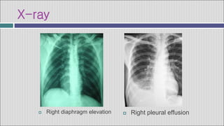 X-ray
 Right pleural effusion
 Right diaphragm elevation
 