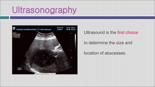 Ultrasonography
Ultrasound is the first choice
to determine the size and
location of abscesses.
 
