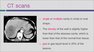 CT scans
 single or multiple cavity in circle or oval
shape.
 The density of the wall is slightly higher
than that of the abscess cavity, which is
lower than that of the normal liver tissue.
 gas or gas liquid level in 20% of the
lesions.
 
