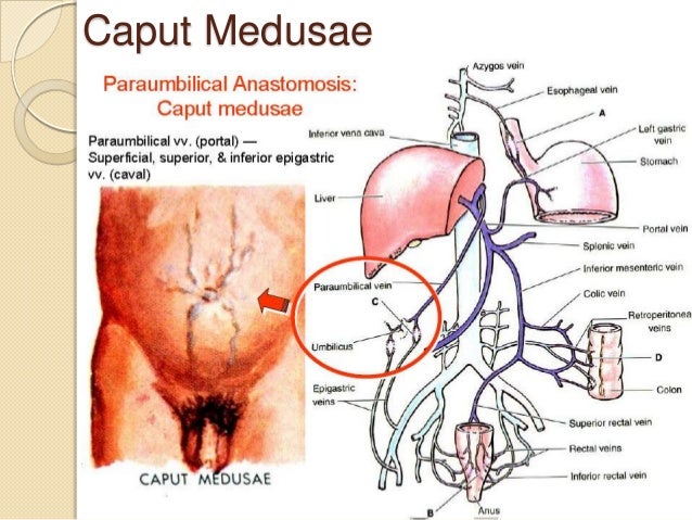 portacaval anastomosis