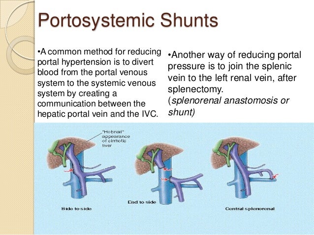 portacaval anastomosis