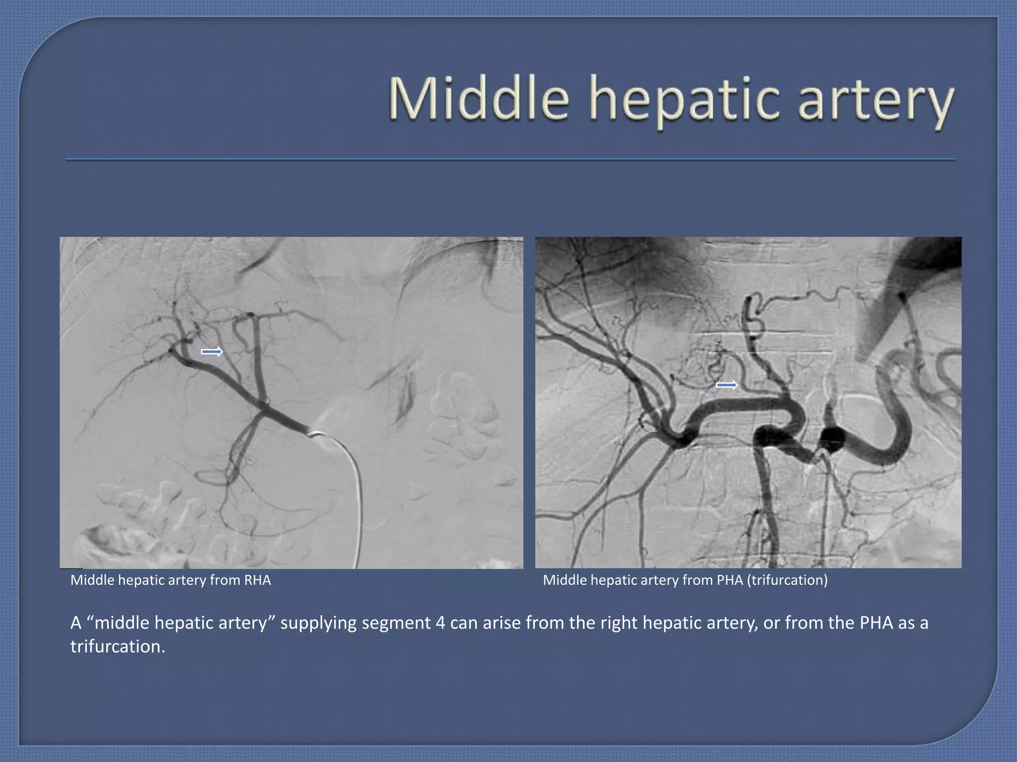 Hepatic arterial anatomy and vascular optimization final | PPTX