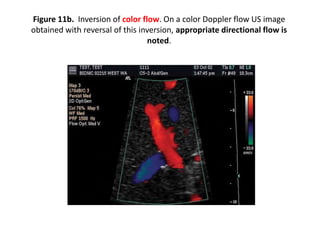 Hepatic doppler us [2] | PPTX