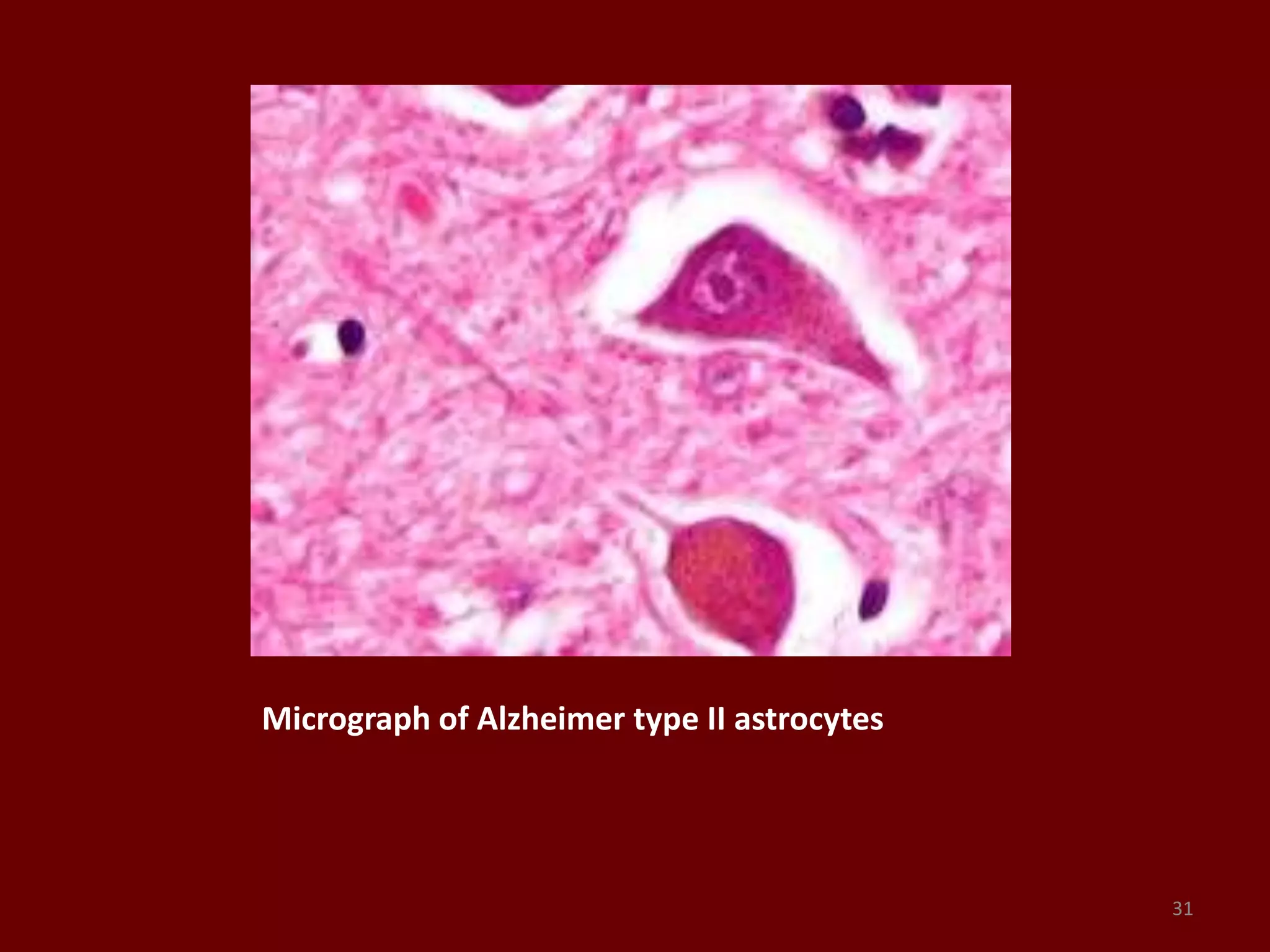 Micrograph of Alzheimer type II astrocytes
31
 