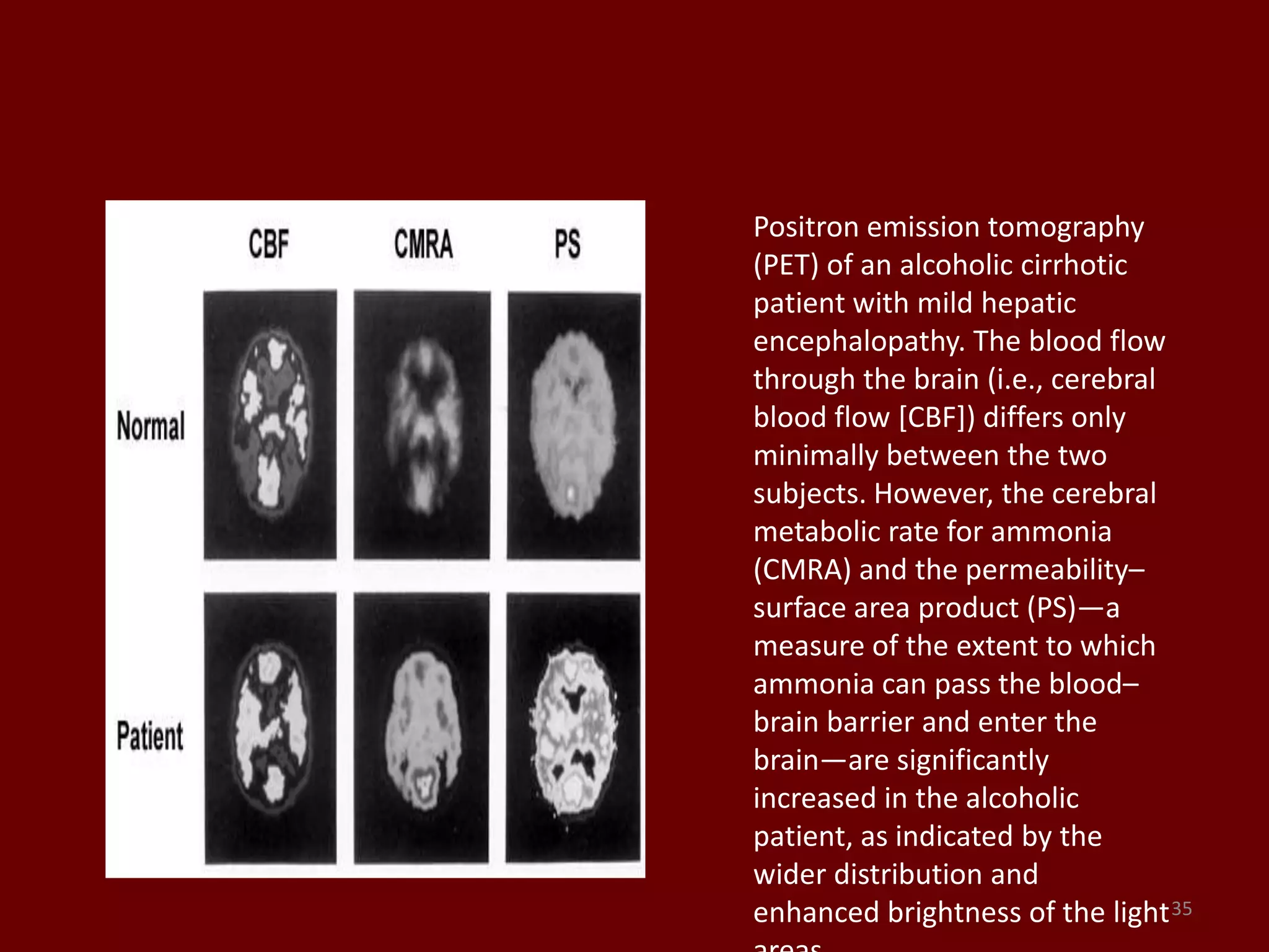 35
Positron emission tomography
(PET) of an alcoholic cirrhotic
patient with mild hepatic
encephalopathy. The blood flow
through the brain (i.e., cerebral
blood flow [CBF]) differs only
minimally between the two
subjects. However, the cerebral
metabolic rate for ammonia
(CMRA) and the permeability–
surface area product (PS)—a
measure of the extent to which
ammonia can pass the blood–
brain barrier and enter the
brain—are significantly
increased in the alcoholic
patient, as indicated by the
wider distribution and
enhanced brightness of the light
 