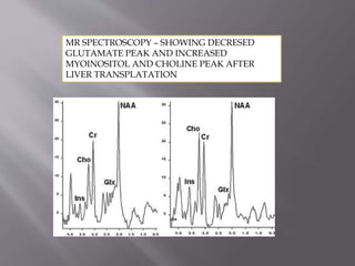 MR SPECTROSCOPY – SHOWING DECRESED
GLUTAMATE PEAK AND INCREASED
MYOINOSITOL AND CHOLINE PEAK AFTER
LIVER TRANSPLATATION
 