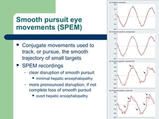 Smooth pursuit eye
movements (SPEM)
 Conjugate movements used to
track, or pursue, the smooth
trajectory of small targets
 SPEM recordings
– clear disruption of smooth pursuit
 minimal hepatic encephalopathy
– more pronounced disruption, if not
complete loss of smooth pursuit
 overt hepatic encephalopathy
 