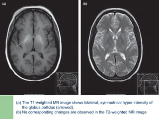 (a) The T1-weighted MR image shows bilateral, symmetrical hyper intensity of
the globus pallidus (arrowed).
(b) No corresponding changes are observed in the T2-weighted MR image
 