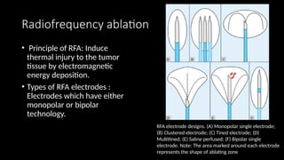 Genicular Rfa Bipolar Role of interventional radiologoly in hepatic lesions.pptx