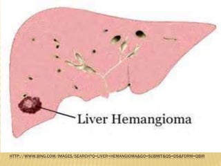 HTTP://WWW.BING.COM/IMAGES/SEARCH?Q=LIVER+HEMANGIOMA&GO=SUBMIT&QS=DS&FORM=QBIR
 