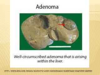 HTTP://WWW.BING.COM/IMAGES/SEARCH?Q=LIVER+ADENOMA&GO=SUBMIT&QS=DS&FORM=QBIRMH
 