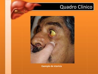 Quadro Clínico
Exemplo de icterícia
 