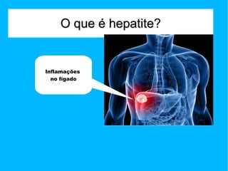 O que é hepatite?
hepatite

Inflamações
no fígado

 