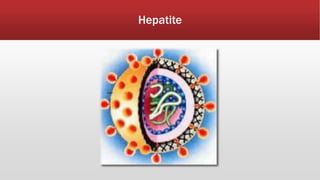 Hepatite 
 