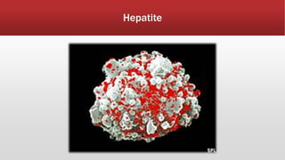Hepatite 
 