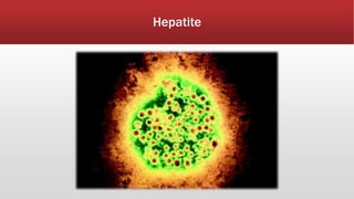 Hepatite 
 