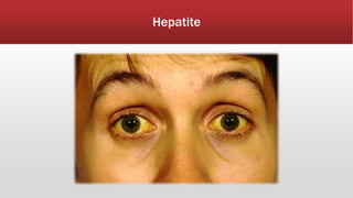 Hepatite 
 