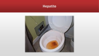 Hepatite 
 