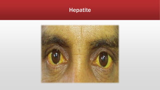 Hepatite 
 