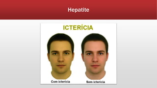 Hepatite 
 