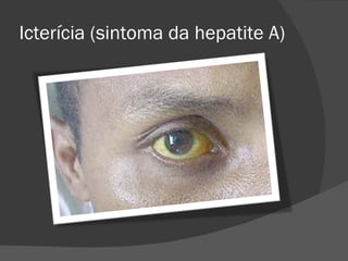 Icterícia (sintoma da hepatite A) 