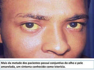 Mais da metade dos pacientes possui conjuntiva do olho e pele 
amarelada, um sintoma conhecido como Icterícia. 
 