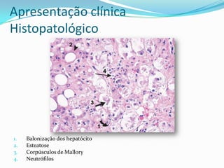 Apresentação clínica
Histopatológico




1.   Balonização dos hepatócito
2.   Esteatose
3.   Corpúsculos de Mallory
4.   Neutrófilos
 