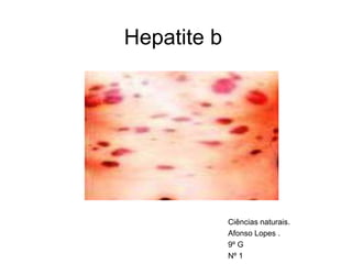 Hepatite b Ciências naturais.  Afonso Lopes . 9º G Nº 1 