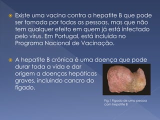  Existe uma vacina contra a hepatite B que pode
ser tomada por todas as pessoas, mas que não
tem qualquer efeito em quem já está infectado
pelo vírus. Em Portugal, está incluída no
Programa Nacional de Vacinação.
 A hepatite B crónica é uma doença que pode
durar toda a vida e dar
origem a doenças hepáticas
graves, incluindo cancro do
fígado.
Fig.1 Fígado de uma pessoa
com hepatite B
 