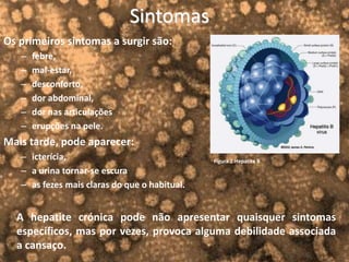 Sintomas
Os primeiros sintomas a surgir são:
– febre,
– mal-estar,
– desconforto,
– dor abdominal,
– dor nas articulações
– erupções na pele.
Mais tarde, pode aparecer:
– icterícia,
– a urina tornar-se escura
– as fezes mais claras do que o habitual.
A hepatite crónica pode não apresentar quaisquer sintomas
específicos, mas por vezes, provoca alguma debilidade associada
a cansaço.
Figura 2:Hepatite B
 
