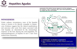 Hepatites Agudas
Namankani , 2008
CCO In Practice, 2013
 