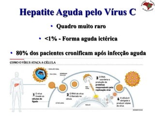 Hepatite Aguda pelo Vírus C
•  Quadro muito raro
•  <1% - Forma aguda ictérica
•  80% dos pacientes cronificam após infecção aguda
 