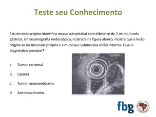 Estudo	endoscópico	idenEﬁca	massa	subepitelial	com	diâmetro	de	2	cm	no	fundo	
gástrico.	Ultrassonograﬁa	endoscópica,	ilustrada	na	ﬁgura	abaixo,	mostra	que	a	lesão	
origina-se	na	muscular	própria	e	a	mucosa	e	submucosa	estão	intactas.	Qual	o	
diagnósEco	provável?	
		
		
a. 	Tumor	estromal	
b.	 	Lipoma	
	
c.	 	Tumor	neuroendócrino	
	
d.	 	Adenocarcinoma		
	
!
Teste	seu	Conhecimento	
 