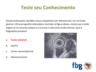 Estudo	endoscópico	idenEﬁca	massa	subepitelial	com	diâmetro	de	2	cm	no	fundo	
gástrico.	Ultrassonograﬁa	endoscópica,	ilustrada	na	ﬁgura	abaixo,	mostra	que	a	lesão	
origina-se	na	muscular	própria	e	a	mucosa	e	submucosa	estão	intactas.	Qual	o	
diagnósEco	provável?	
		
		
a. 	Tumor	estromal	
b.	 	Lipoma	
	
c.	 	Tumor	neuroendócrino	
	
d.	 	Adenocarcinoma		
	
!
Teste	seu	Conhecimento	
 