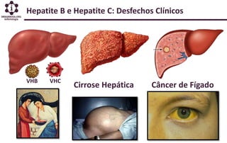 Hepatite B e Hepatite C: Desfechos Clínicos
Cirrose Hepática Câncer de Fígado
VHB VHC
 